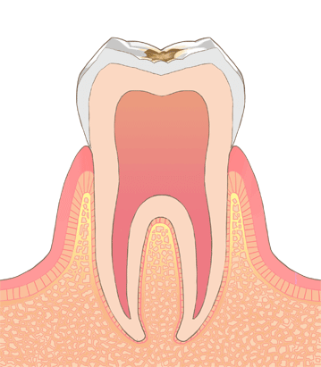 むし歯の治療方法：C1の状態についての画像